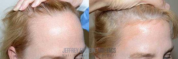 Before & After Hair Transplants For Women Case 201 View 3 View in Miami, FL