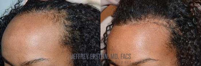 Before & After Hair Transplants For Women Case 203 View 1 View in Miami, FL