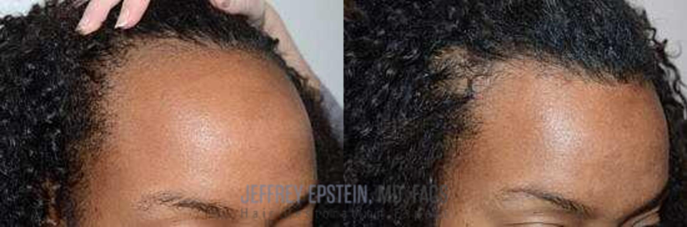 Before & After Hair Transplants For Women Case 203 View 2 View in Miami, FL