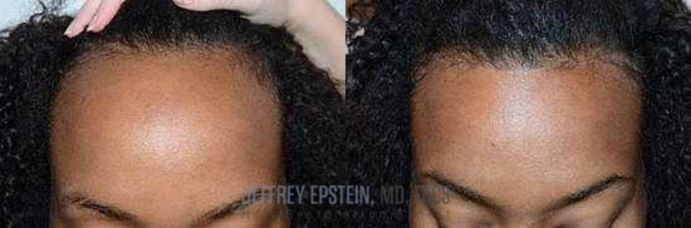Before & After Hair Transplants For Women Case 203 View 3 View in Miami, FL