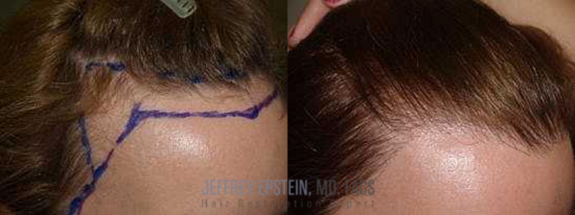 Before & After Hair Transplants For Women Case 204 View 1 View in Miami, FL