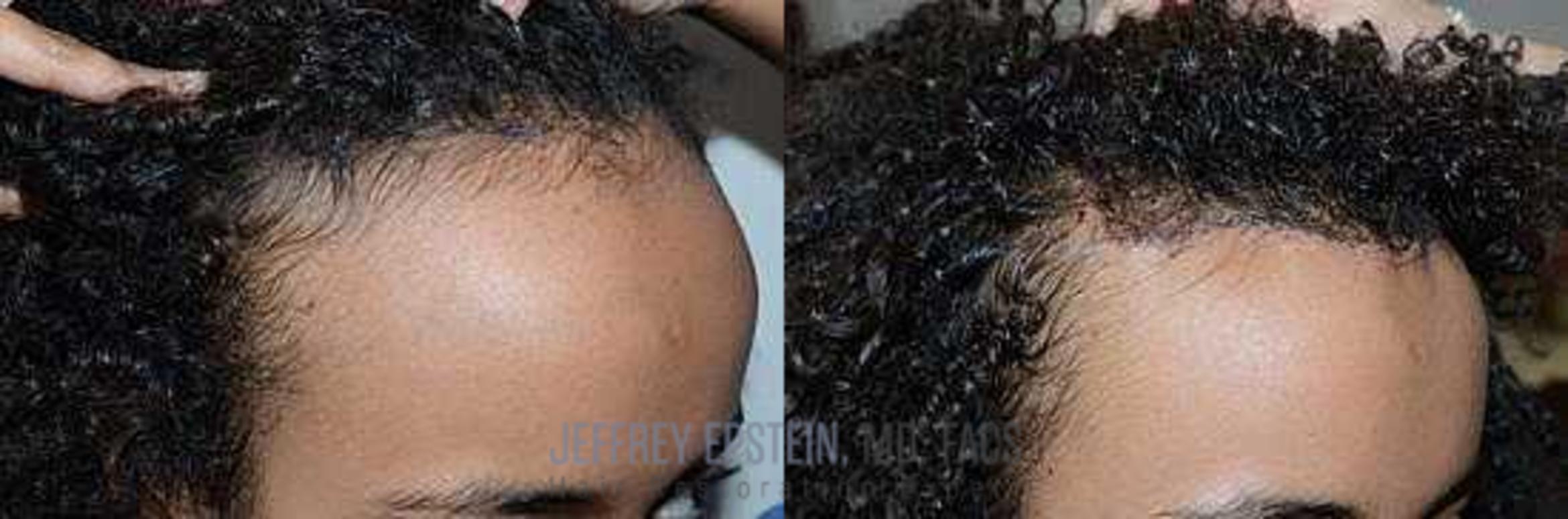 Before & After Hair Transplants For Women Case 205 View 1 View in Miami, FL