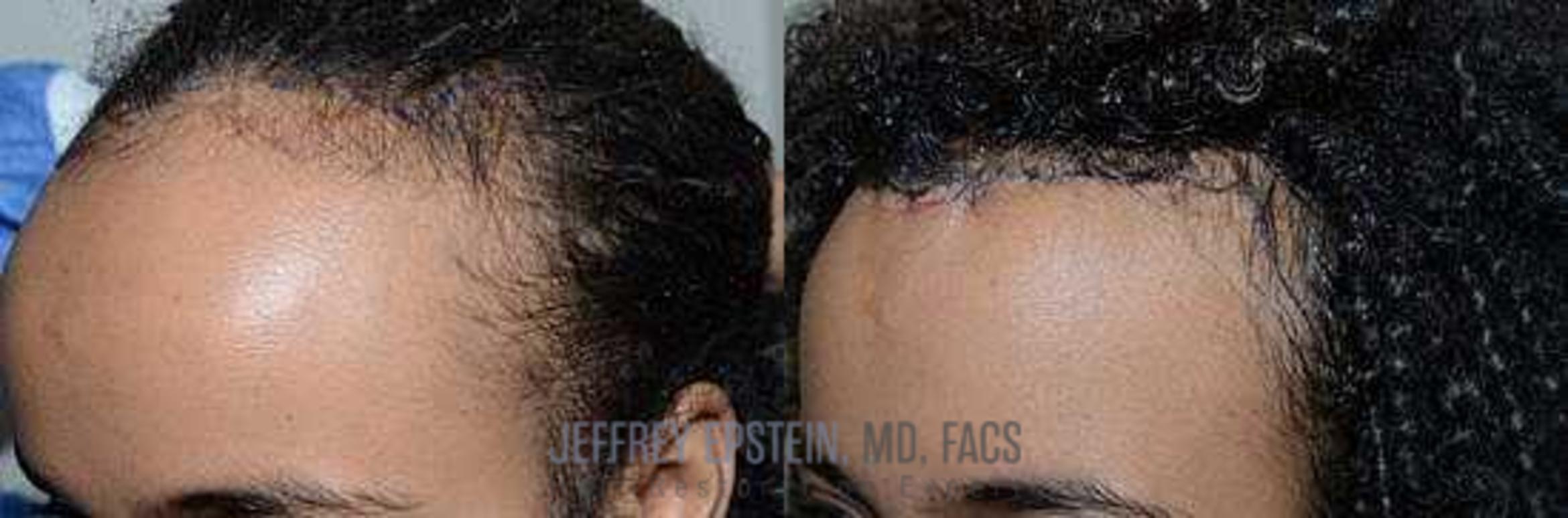 Before & After Hair Transplants For Women Case 205 View 2 View in Miami, FL