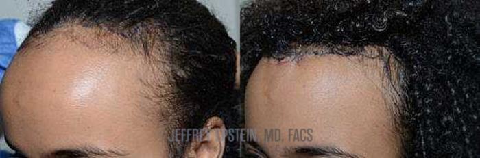 Before & After Hair Transplants For Women Case 205 View 2 View in Miami, FL