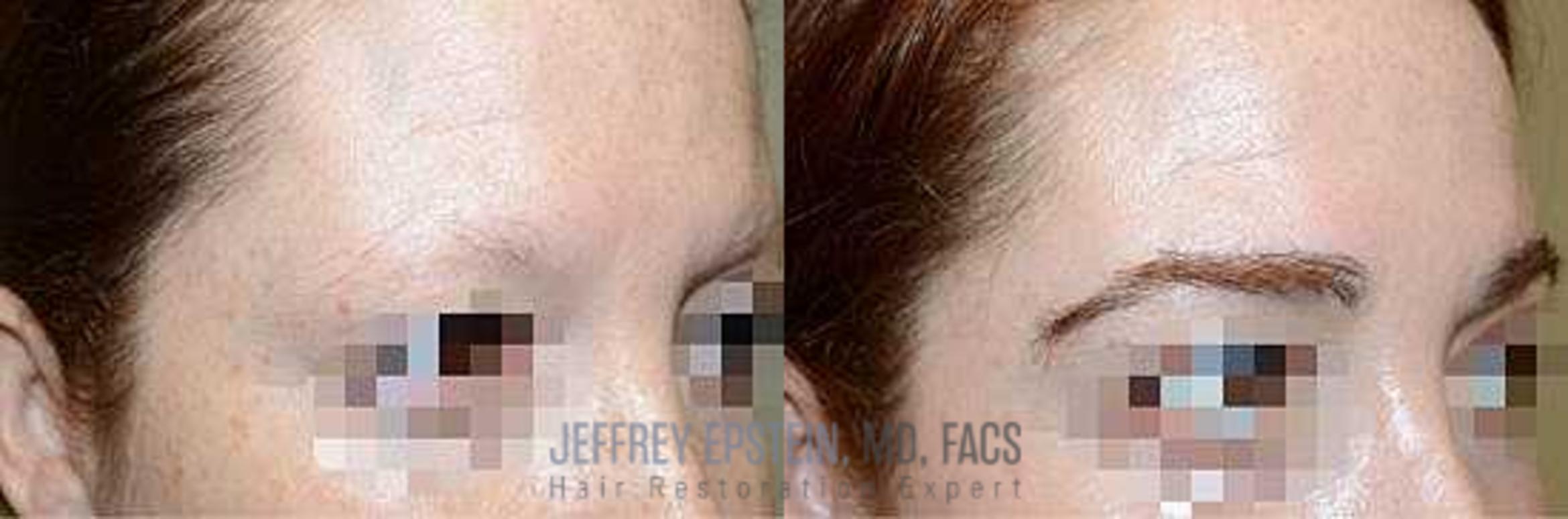 Before & After Hair Transplants For Women Case 206 View 1 View in Miami, FL