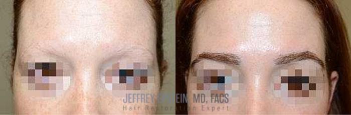 Before & After Hair Transplants For Women Case 206 View 2 View in Miami, FL