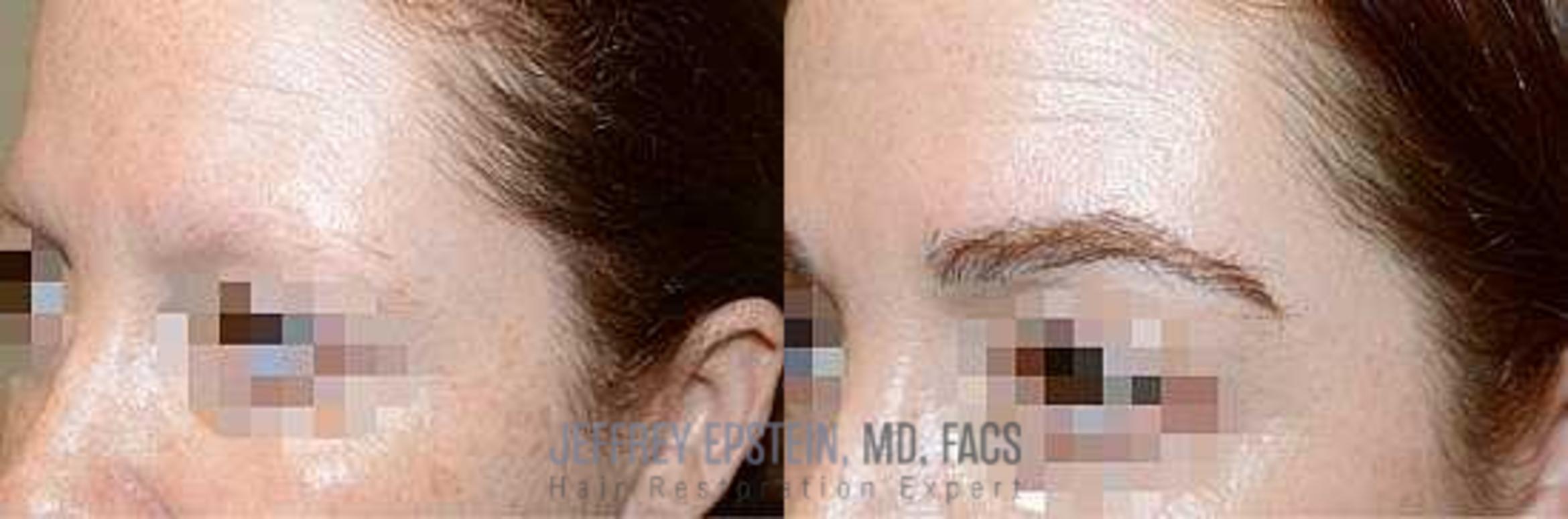 Before & After Hair Transplants For Women Case 206 View 3 View in Miami, FL