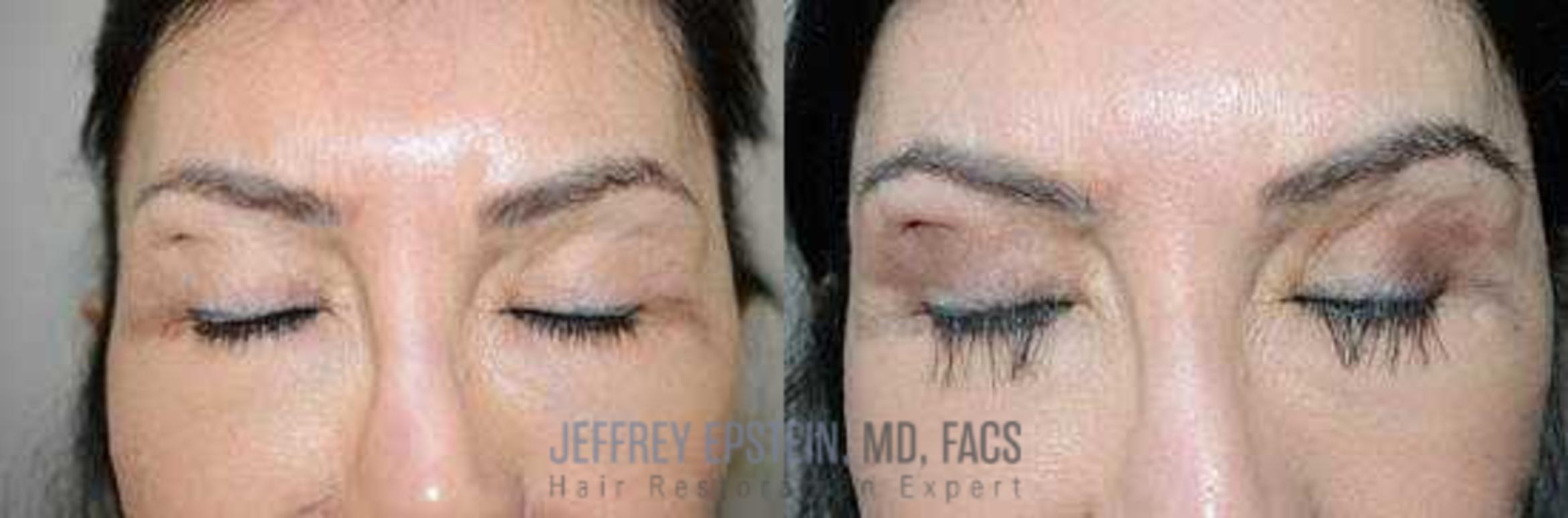 Before & After Hair Transplants For Women Case 207 View 1 View in Miami, FL