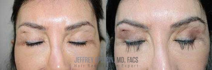 Before & After Hair Transplants For Women Case 207 View 1 View in Miami, FL