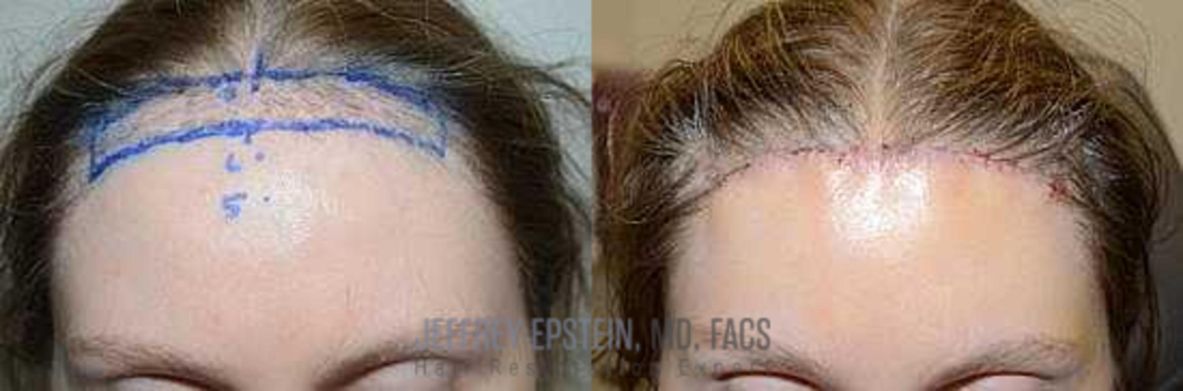 Before & After Hair Transplants For Women Case 208 View 1 View in Miami, FL