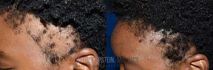 Before & After Hair Transplants For Women Case 209 View 1 View in Miami, FL