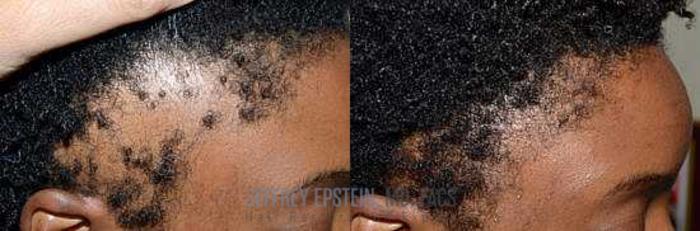 Before & After Hair Transplants For Women Case 209 View 2 View in Miami, FL