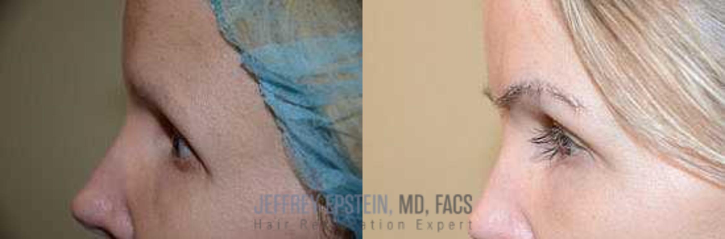 Before & After Hair Transplants For Women Case 212 View 1 View in Miami, FL