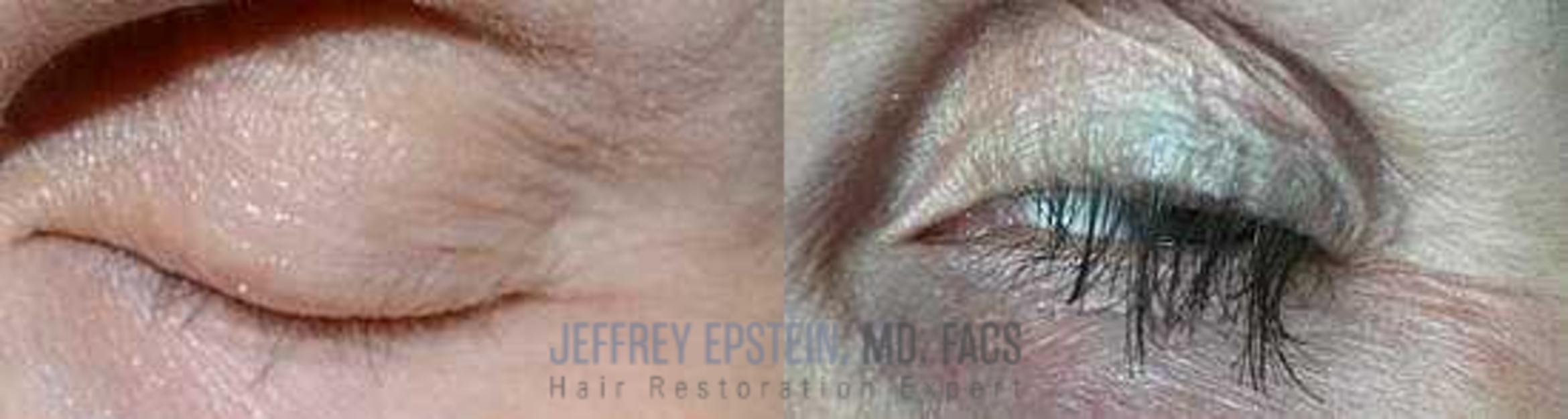 Before & After Hair Transplants For Women Case 212 View 2 View in Miami, FL
