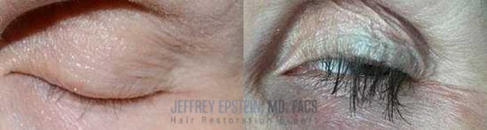 Before & After Hair Transplants For Women Case 212 View 2 View in Miami, FL