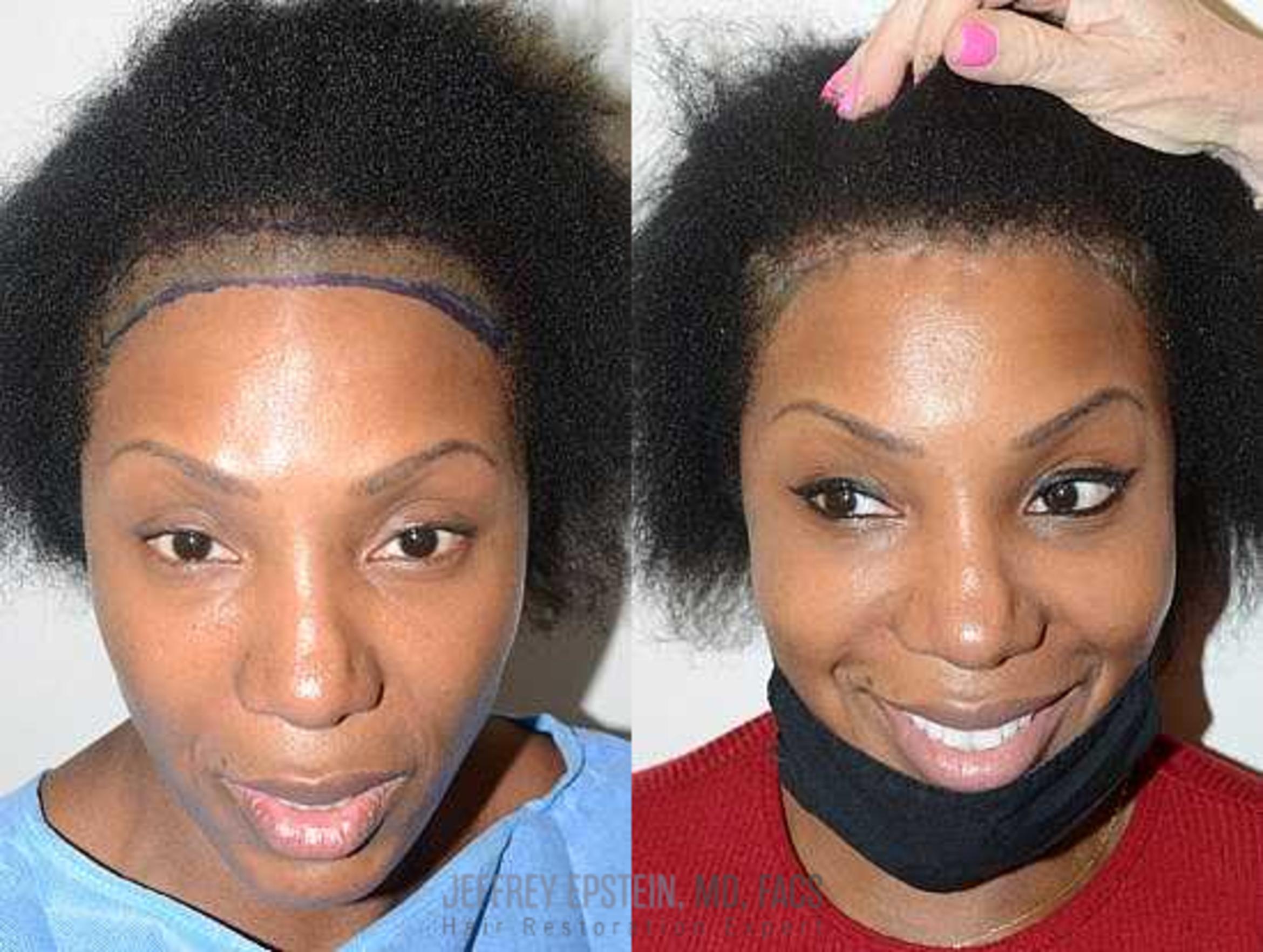 Before & After Hair Transplants For Women Case 214 View 1 View in Miami, FL