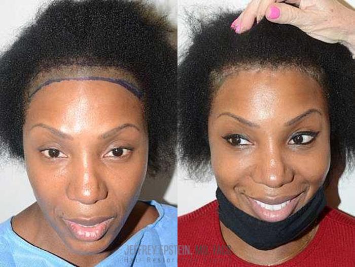 Before & After Hair Transplants For Women Case 214 View 1 View in Miami, FL