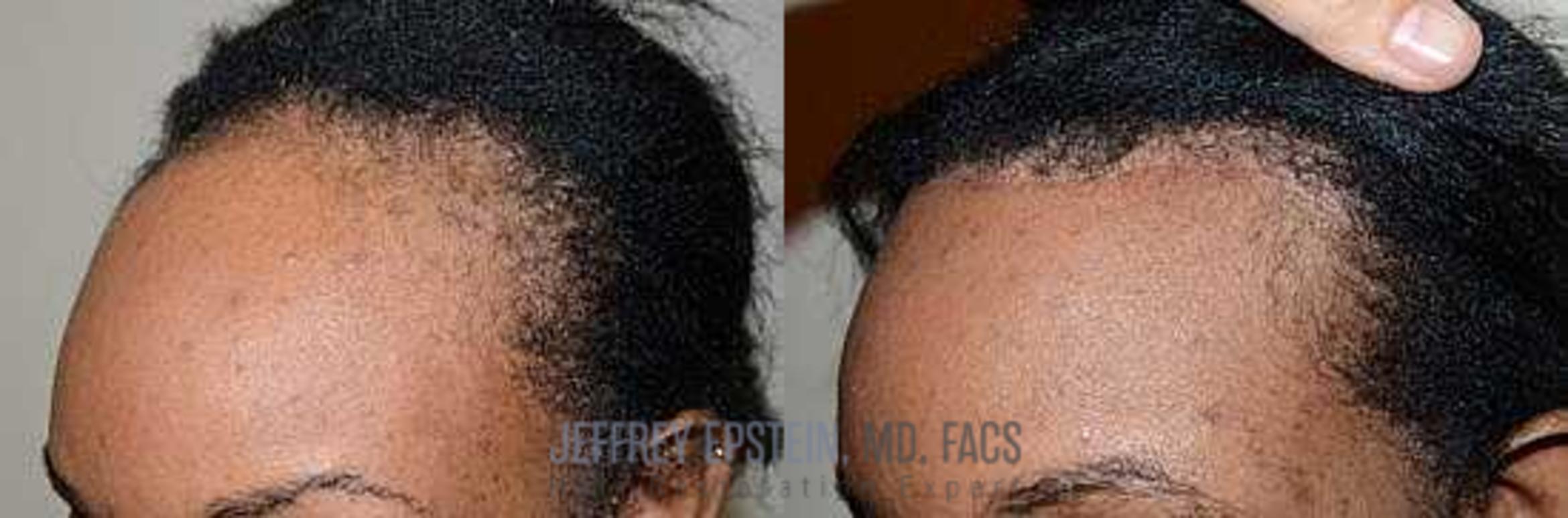 Before & After Hair Transplants For Women Case 216 View 1 View in Miami, FL