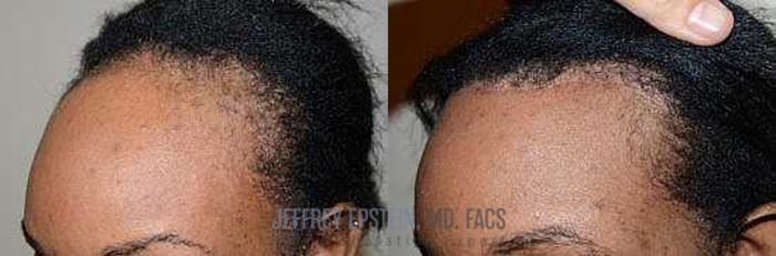 Before & After Hair Transplants For Women Case 216 View 1 View in Miami, FL
