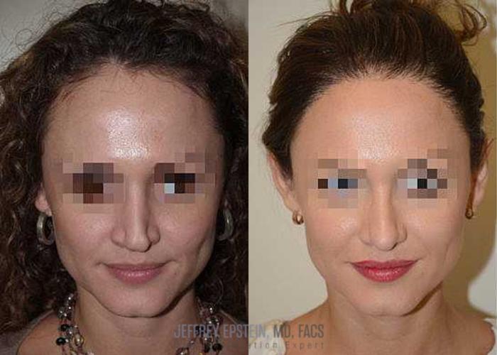 Before & After Hair Transplants For Women Case 217 View 1 View in Miami, FL