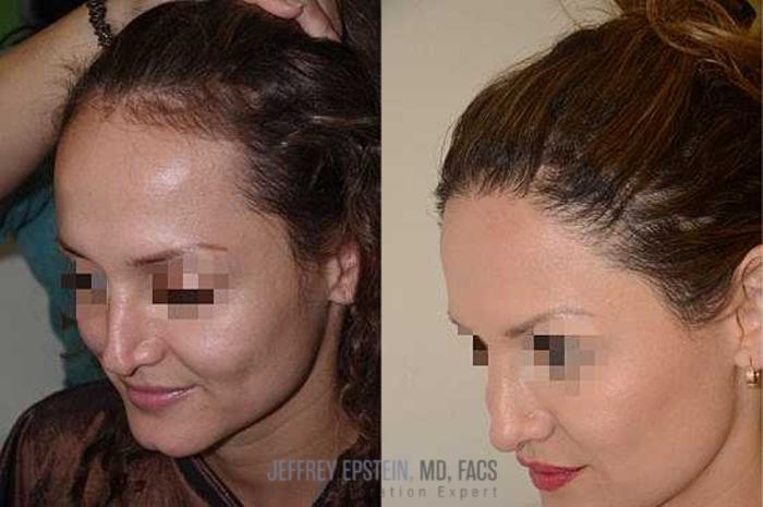 Before & After Hair Transplants For Women Case 217 View 2 View in Miami, FL