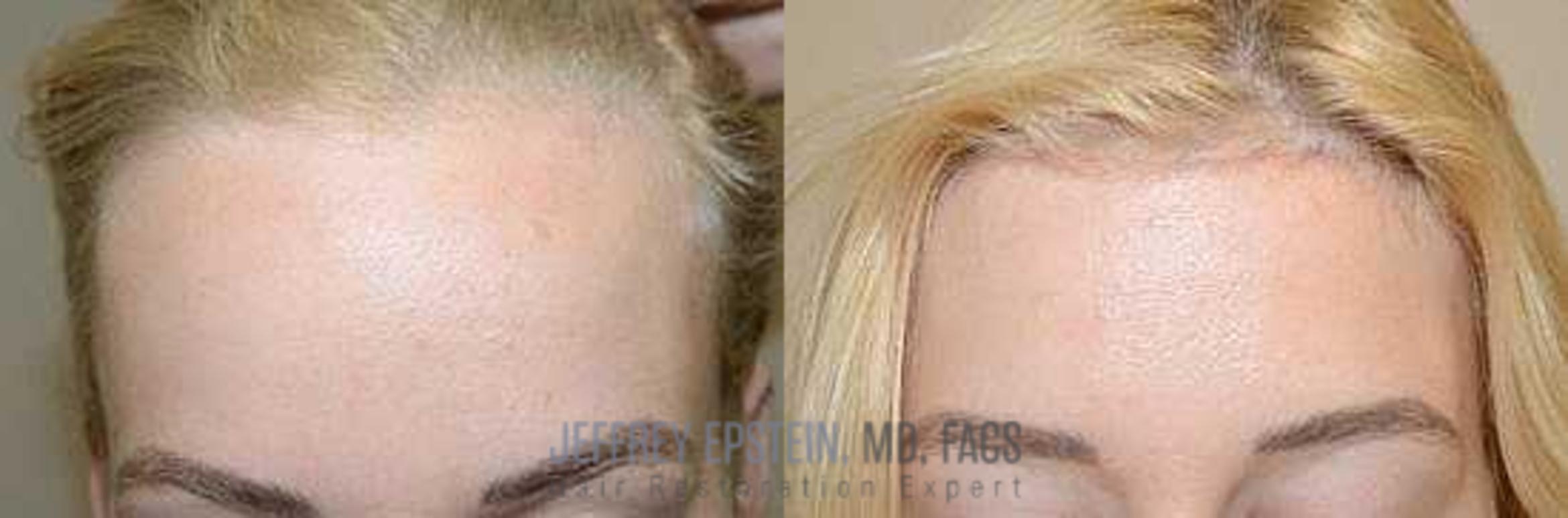 Before & After Hair Transplants For Women Case 218 View 1 View in Miami, FL