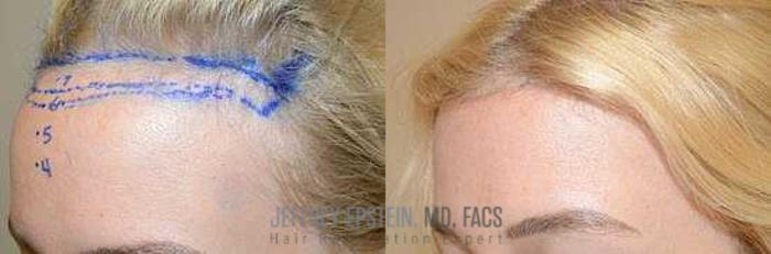 Before & After Hair Transplants For Women Case 218 View 4 View in Miami, FL