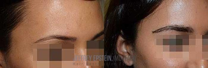 Before & After Hair Transplants For Women Case 219 View 3 View in Miami, FL