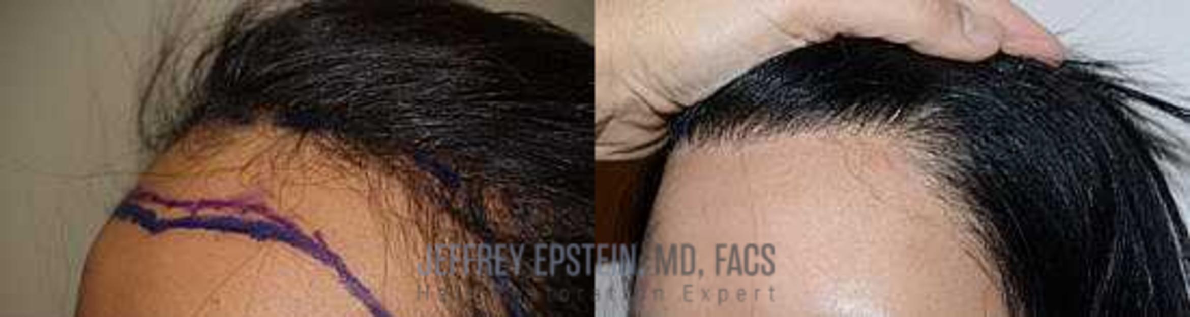 Before & After Hair Transplants For Women Case 221 View 1 View in Miami, FL