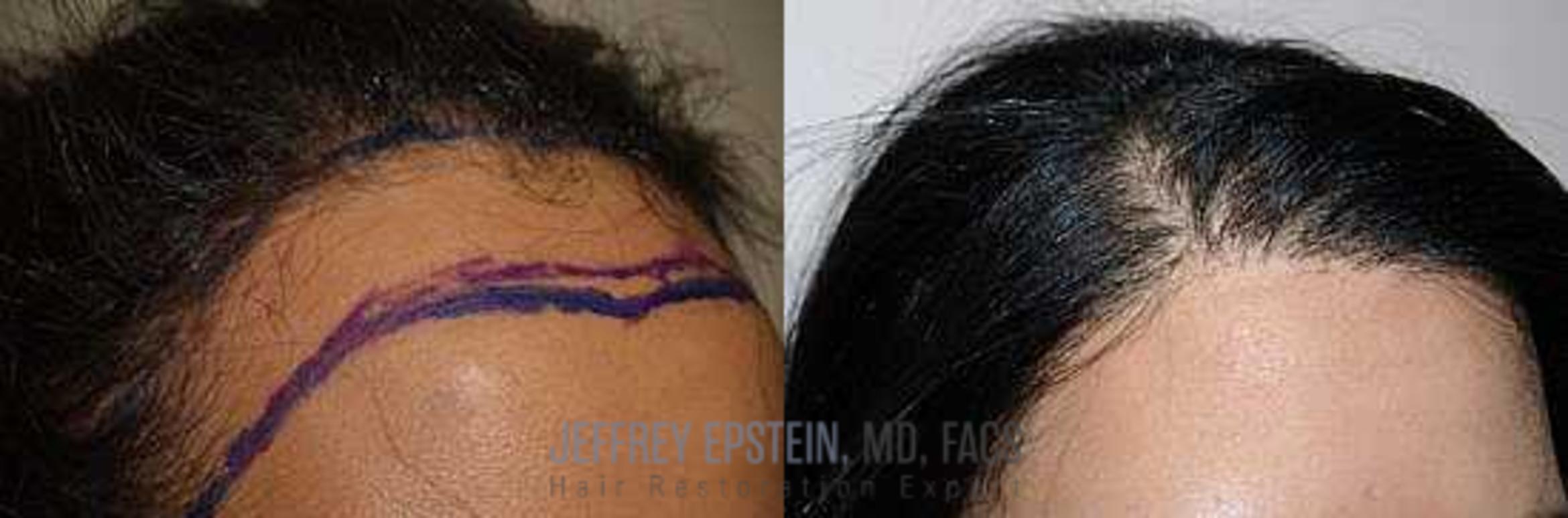 Before & After Hair Transplants For Women Case 221 View 2 View in Miami, FL