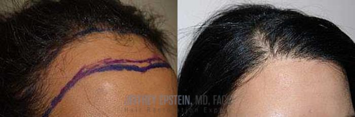 Before & After Hair Transplants For Women Case 221 View 2 View in Miami, FL
