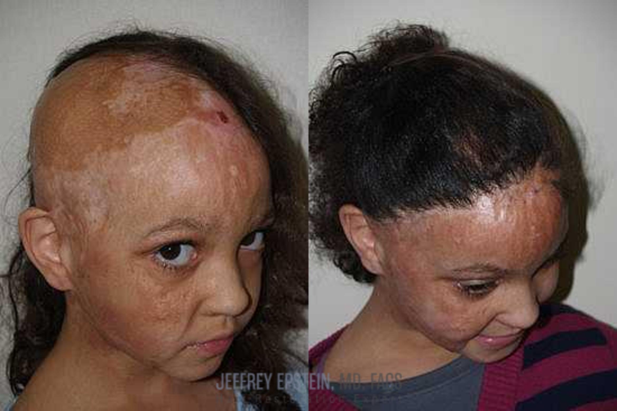 Before & After Hair Transplants For Women Case 222 View 1 View in Miami, FL