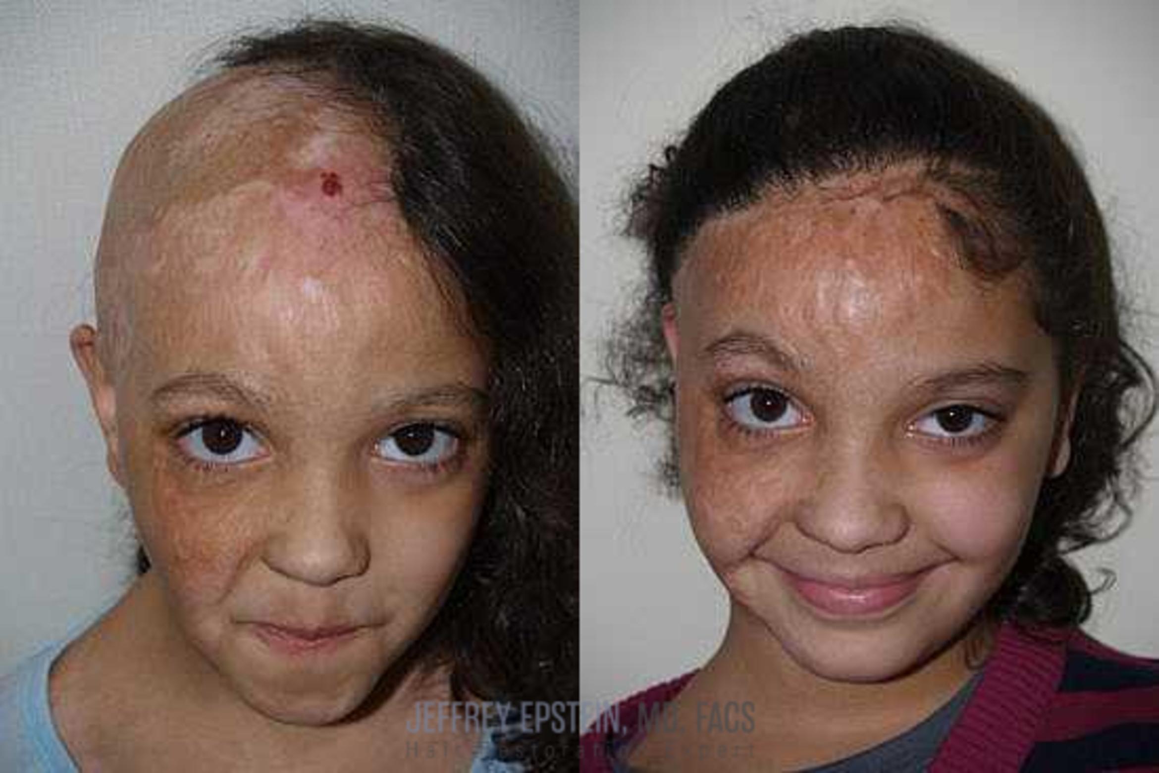 Before & After Hair Transplants For Women Case 222 View 2 View in Miami, FL