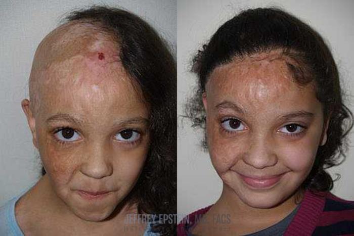 Before & After Hair Transplants For Women Case 222 View 2 View in Miami, FL