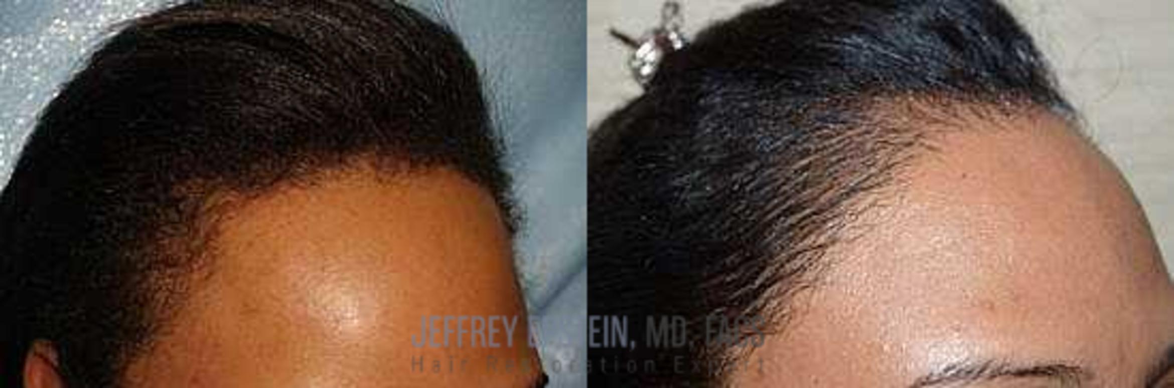 Before & After Hair Transplants For Women Case 223 View 2 View in Miami, FL