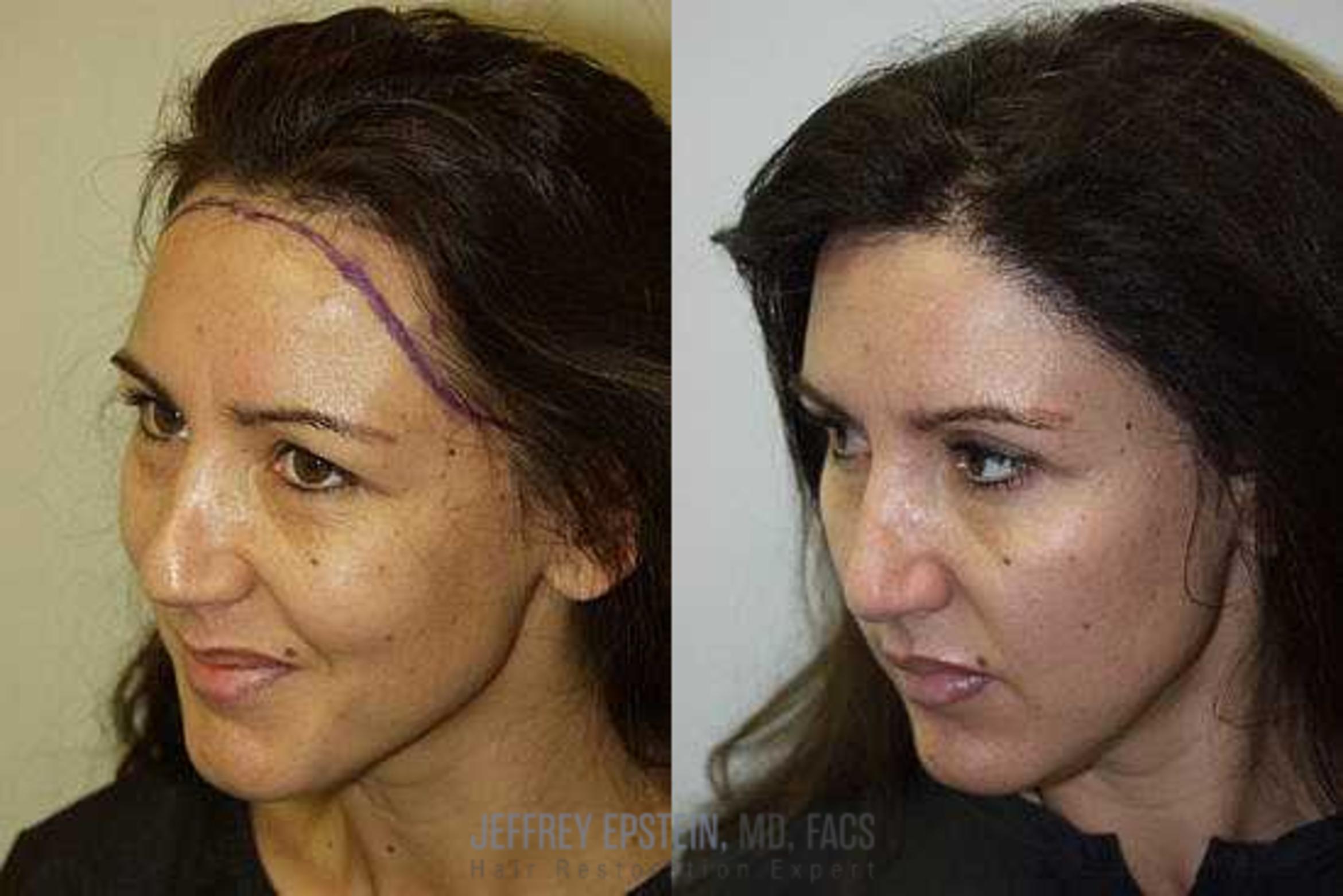 Before & After Hair Transplants For Women Case 224 View 1 View in Miami, FL
