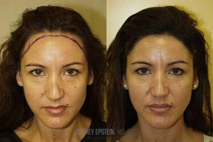 Before & After Hair Transplants For Women Case 224 View 2 View in Miami, FL