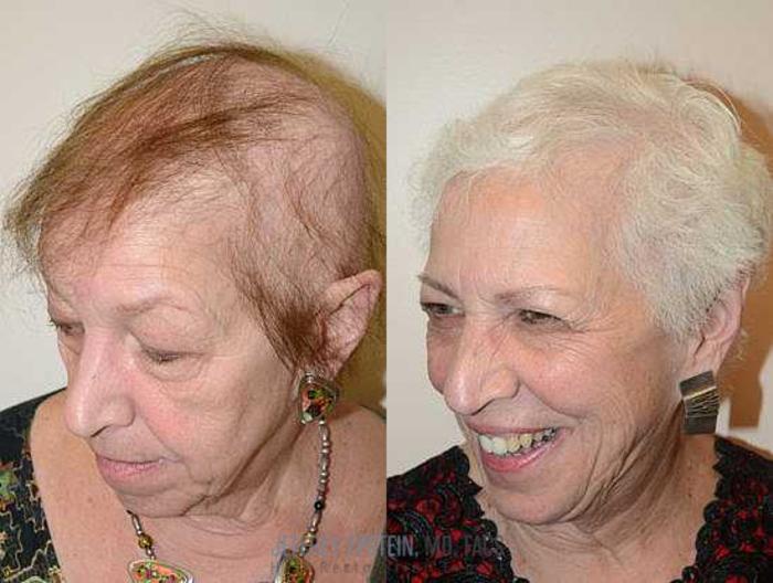 Before & After Hair Transplants For Women Case 225 View 1 View in Miami, FL