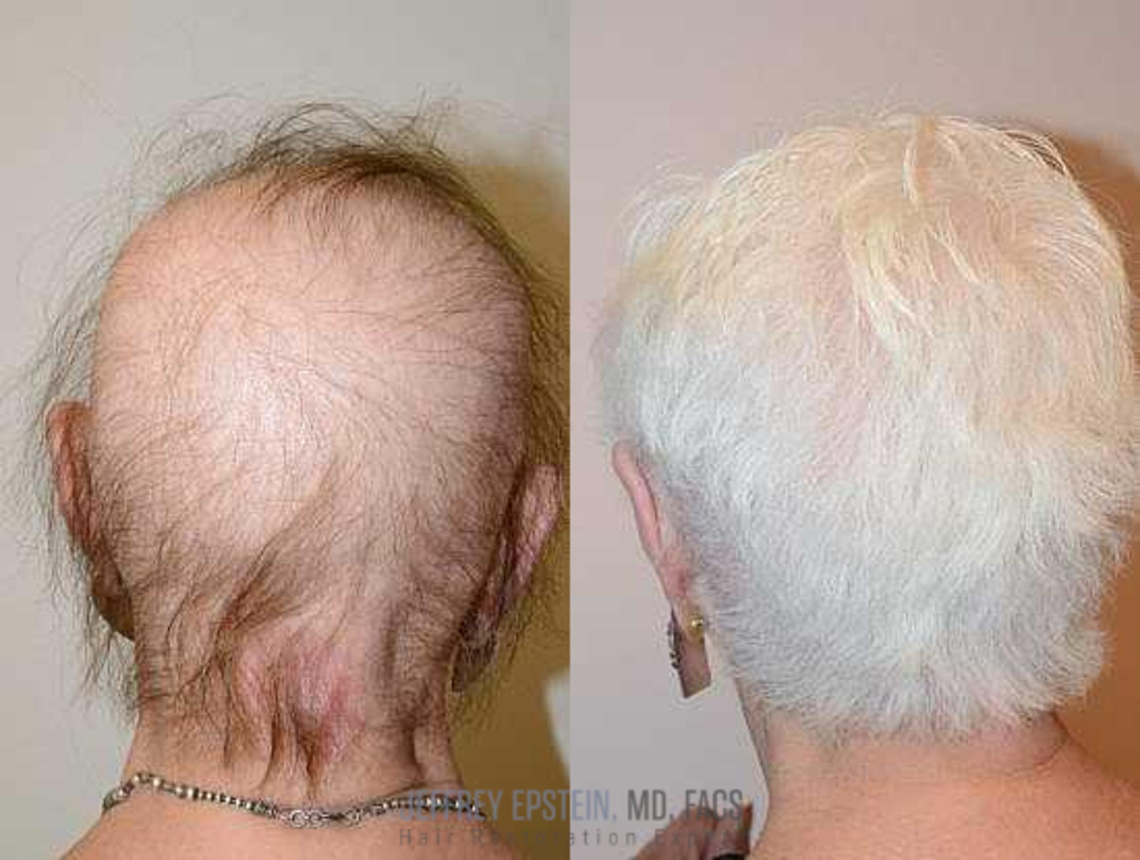 Before & After Hair Transplants For Women Case 225 View 2 View in Miami, FL