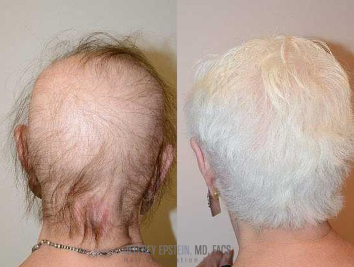 Before & After Hair Transplants For Women Case 225 View 2 View in Miami, FL
