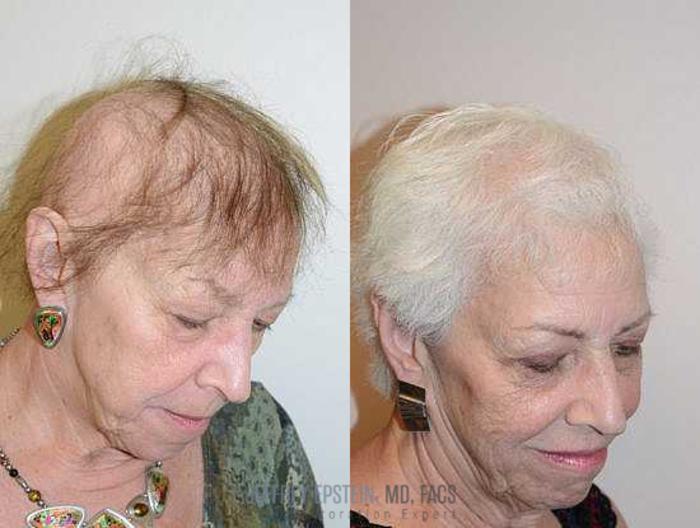 Before & After Hair Transplants For Women Case 225 View 3 View in Miami, FL