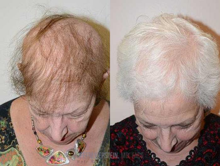 Before & After Hair Transplants For Women Case 225 View 4 View in Miami, FL