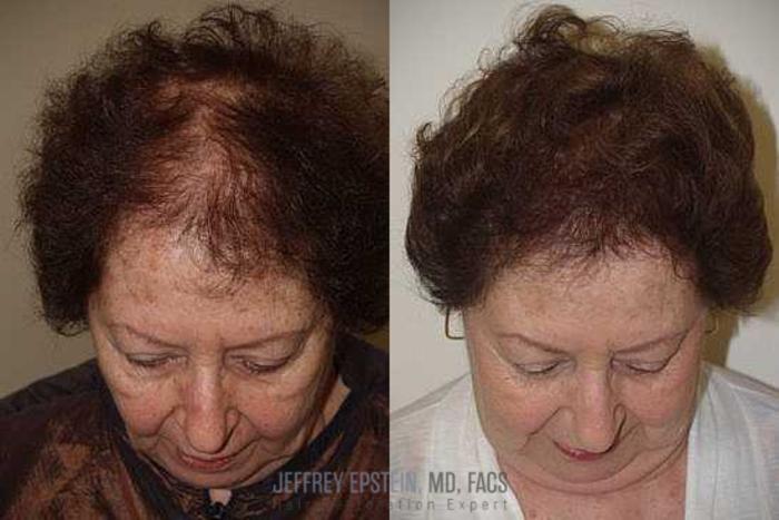 Before & After Hair Transplants For Women Case 226 View 1 View in Miami, FL