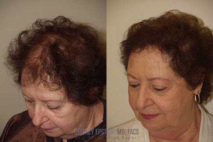 Before & After Hair Transplants For Women Case 226 View 2 View in Miami, FL