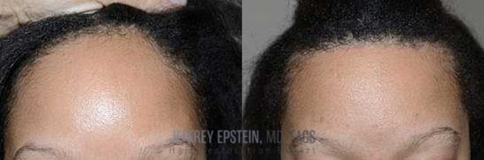 Before & After Hair Transplants For Women Case 228 View 3 View in Miami, FL
