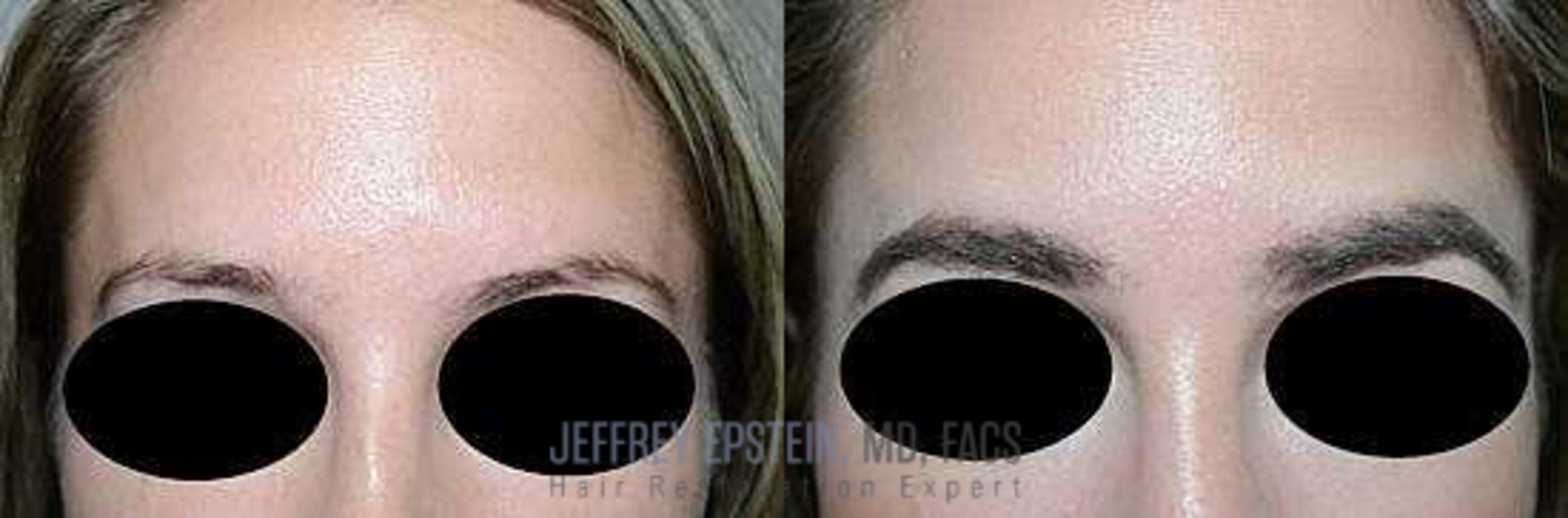 Before & After Hair Transplants For Women Case 229 View 1 View in Miami, FL