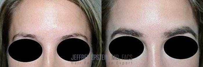 Before & After Hair Transplants For Women Case 229 View 1 View in Miami, FL