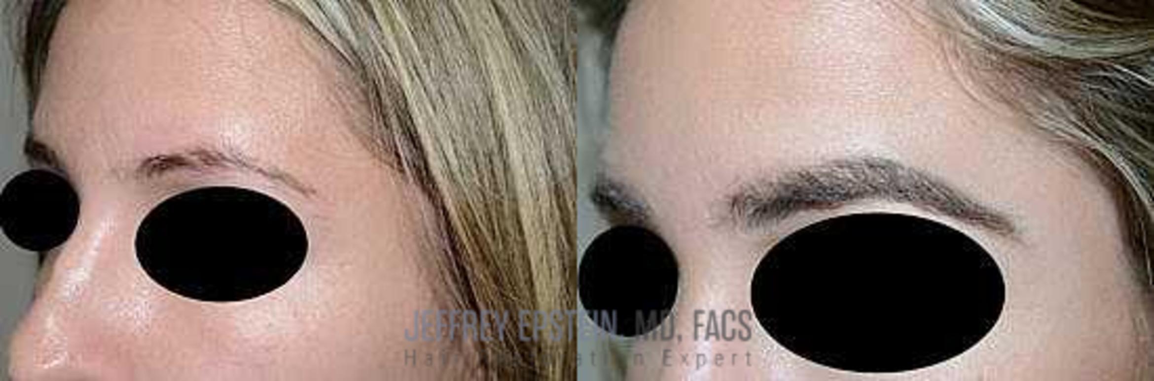 Before & After Hair Transplants For Women Case 229 View 2 View in Miami, FL