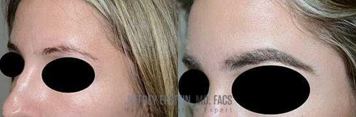 Before & After Hair Transplants For Women Case 229 View 2 View in Miami, FL