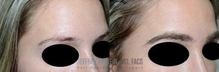 Before & After Hair Transplants For Women Case 229 View 3 View in Miami, FL